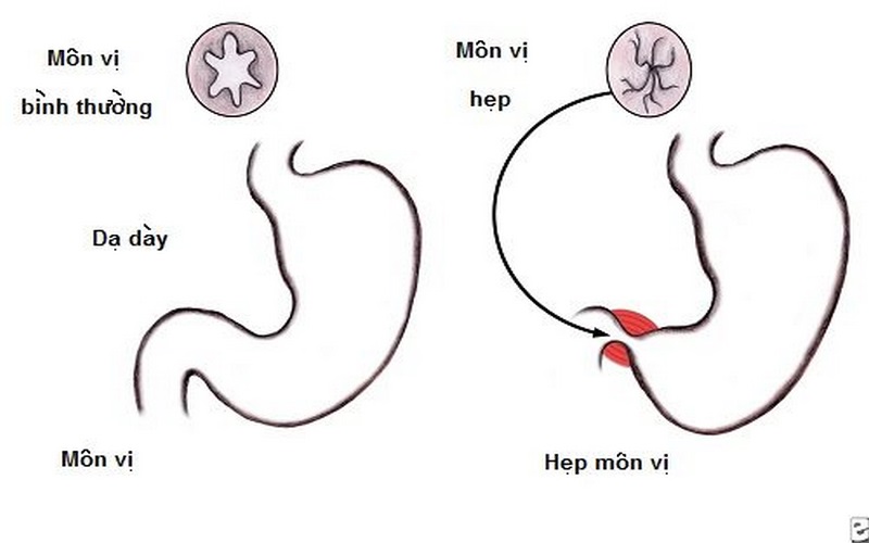 Phẫu thuật là phương án điều trị phổ biến với hẹp phì đại môn vị bẩm sinh.