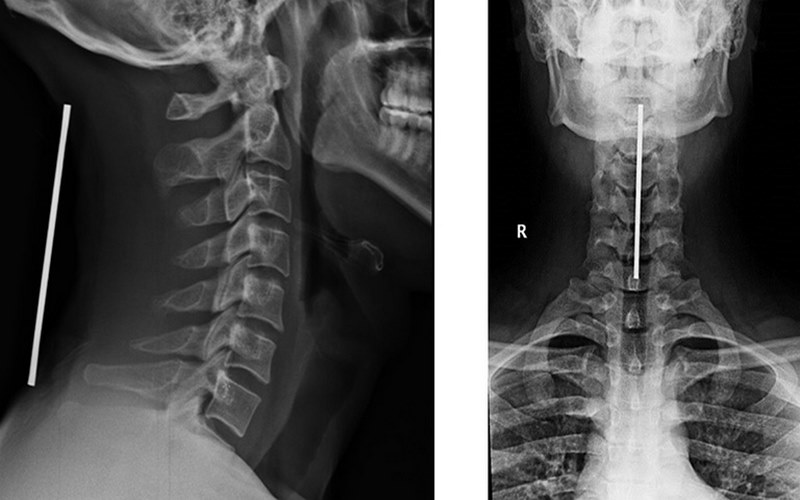 Đau hoặc tê yếu tay có thể là triệu chứng của hẹp lỗ liên hợp đốt sống cổ