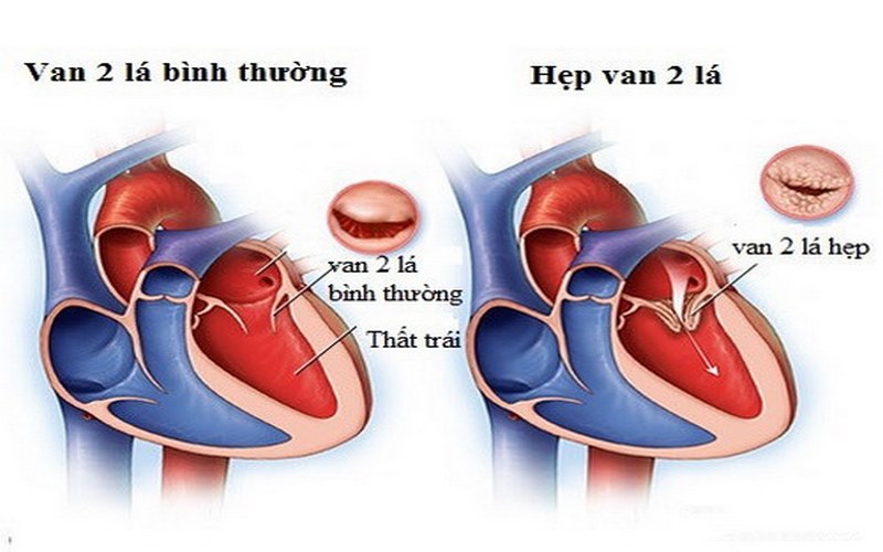 Bệnh lý Hẹp van hai lá