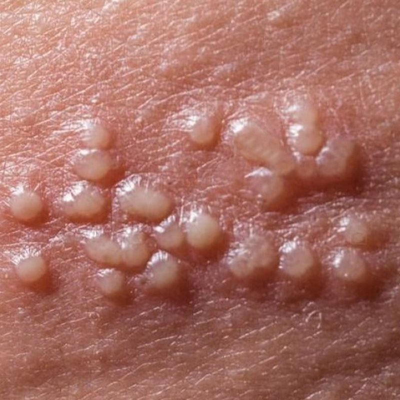 Tìm hiểu chung về herpes hậu môn