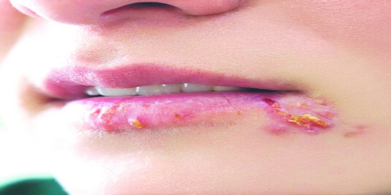 Tiếp xúc với người đã nhiễm virus Herpes simplex