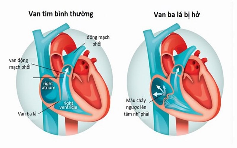 Hở van 3 lá là bệnh tim mạch nguy hiểm