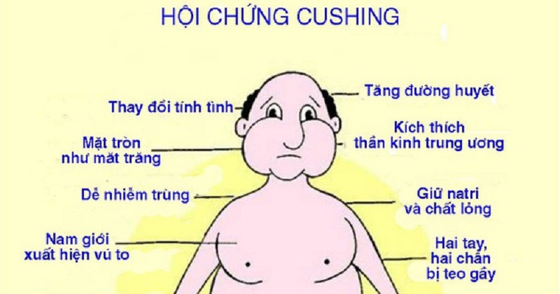 Triệu chứng thường gặp ở người bị hội chứng Cushing 