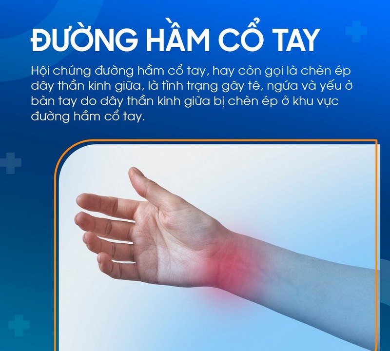 Hội chứng đường hầm cổ tay: Nguyên nhân và cách phòng ngừa