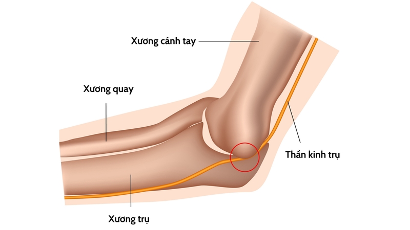 Những ai có nguy cơ mắc phải hội chứng đường hầm xương trụ