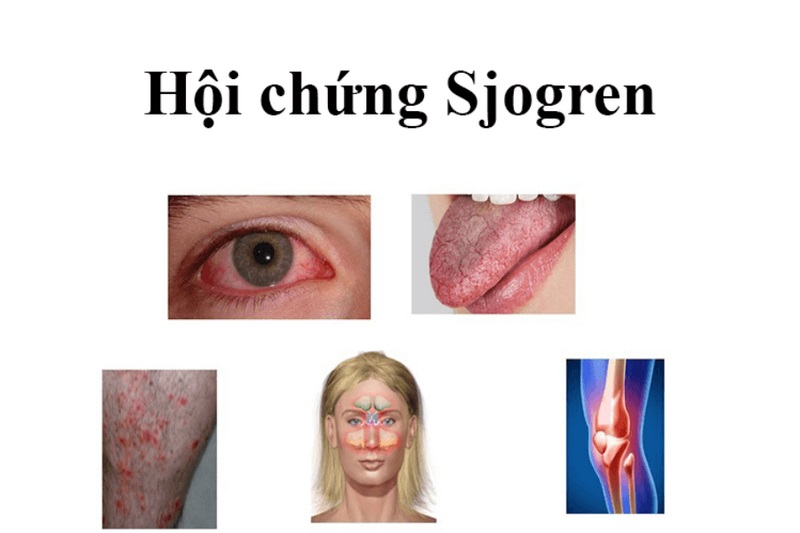 dấu hiệu và triệu chứng phổ biến của hội chứng Sjogren