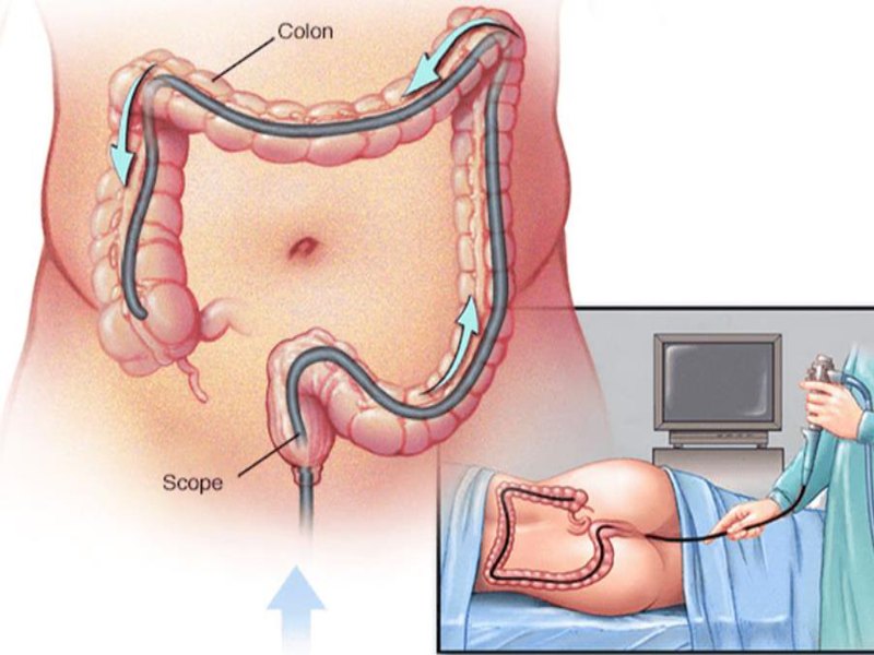 Nội soi sinh thiết đại trực tràng