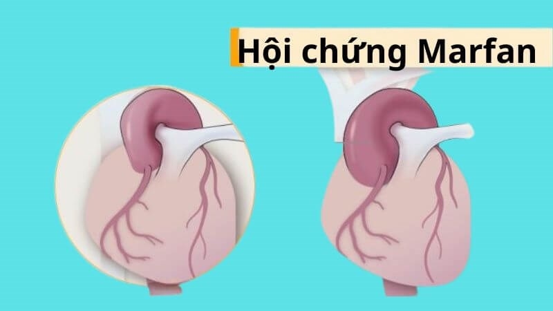 Hội chứng Marfan cần được thực hiện một cách kỹ lưỡng