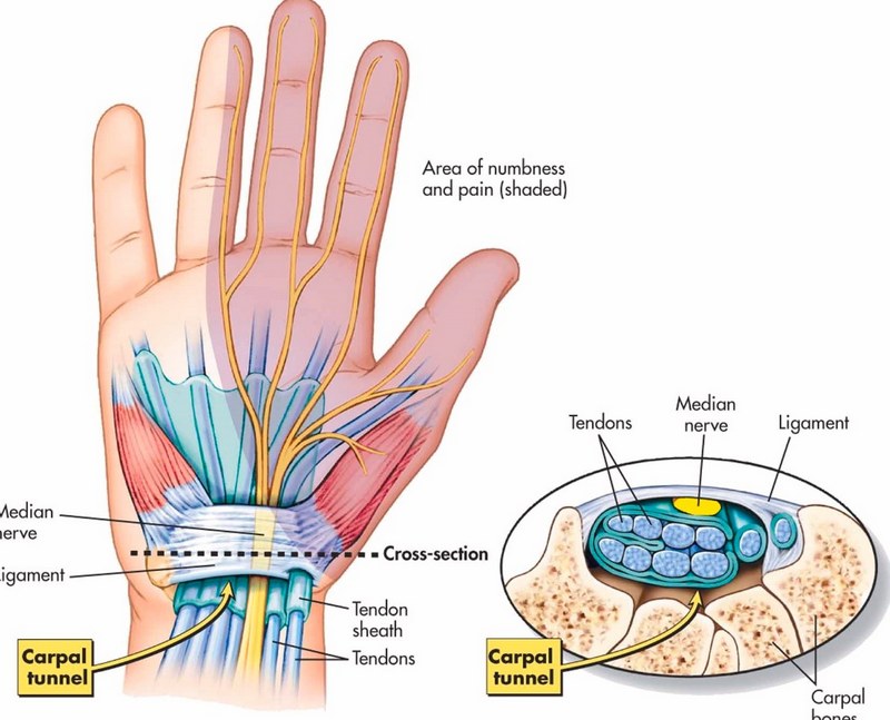 Tìm hiểu chung về hội chứng ống cổ tay