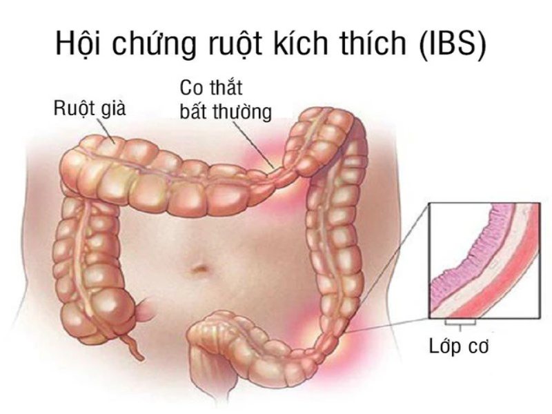 Hội chứng ruột kích thích thường gặp ở người trẻ tuổi