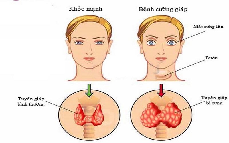 Người bị cường giáp thường hay cảm thấy hồi hộp, nhịp tim nhanh hơn bình thường