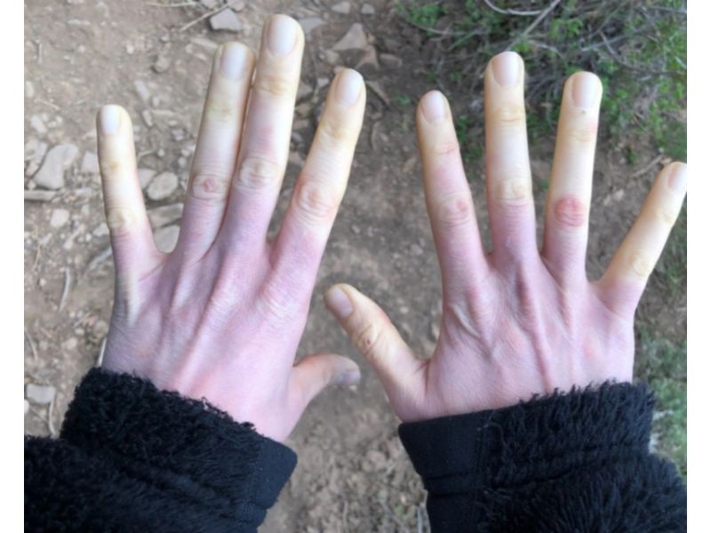 Hội chứng Raynaud xảy ra do sự co thắt ở các động mạch làm giảm dòng máu đến các mô