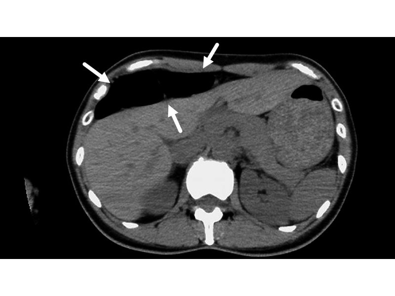 Hình ảnh CT scan trong hội chứng Chilaiditi