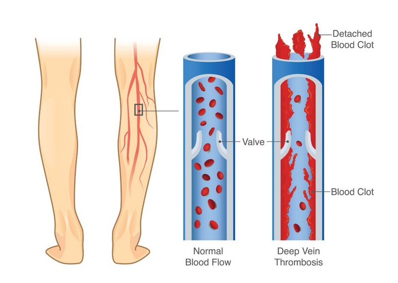Tìm hiểu chung về bệnh huyết khối tĩnh mạch sâu