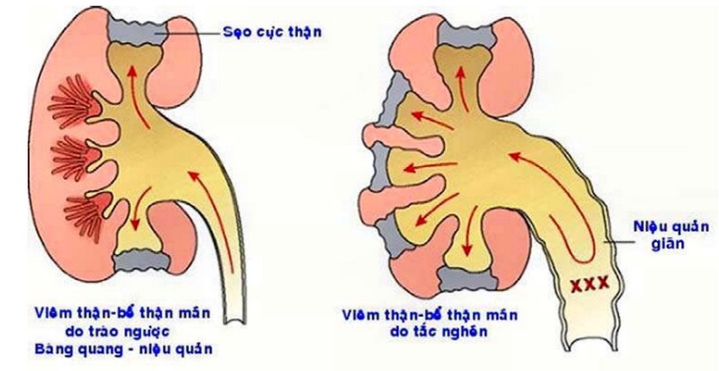 Huyết áp càng cao, nguy cơ mắc bệnh thận càng tăng