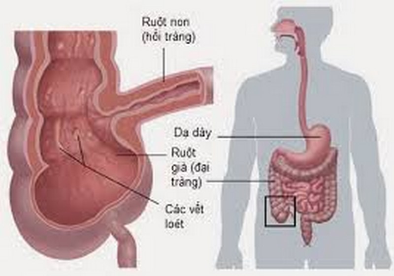 Người có nguy cơ mắc phải nhiễm Clostridium botulinum