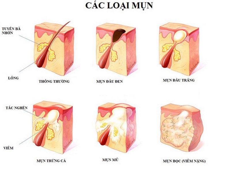 Các nốt mụn nhỏ trên da, thường xanh hoặc đỏ