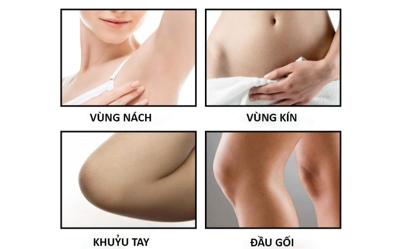 Kem dưỡng trắng cho các vùng da có độ thâm sạm cao