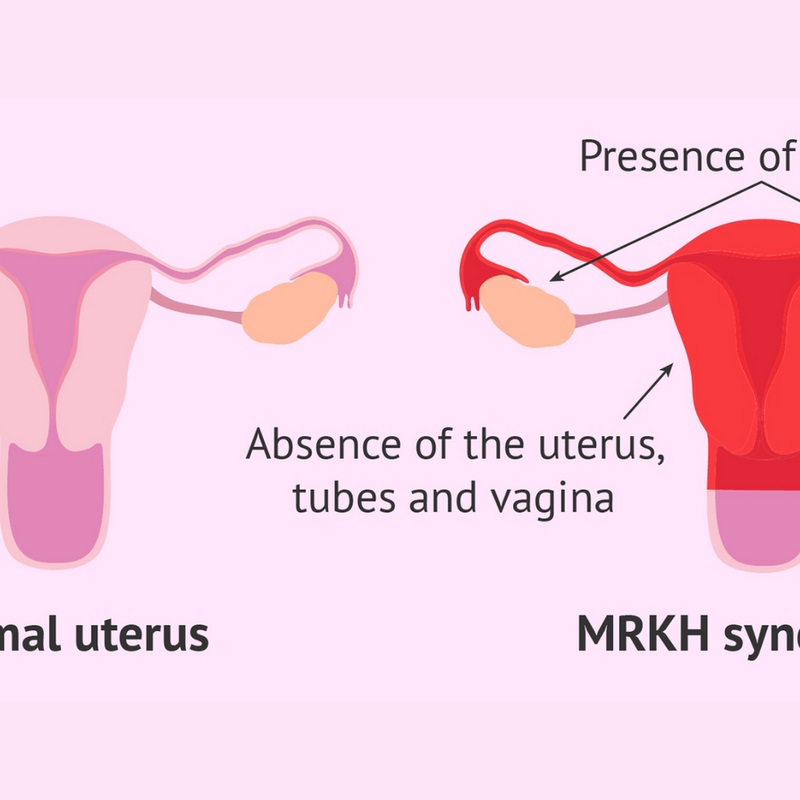 Tìm hiểu về không có âm đạo