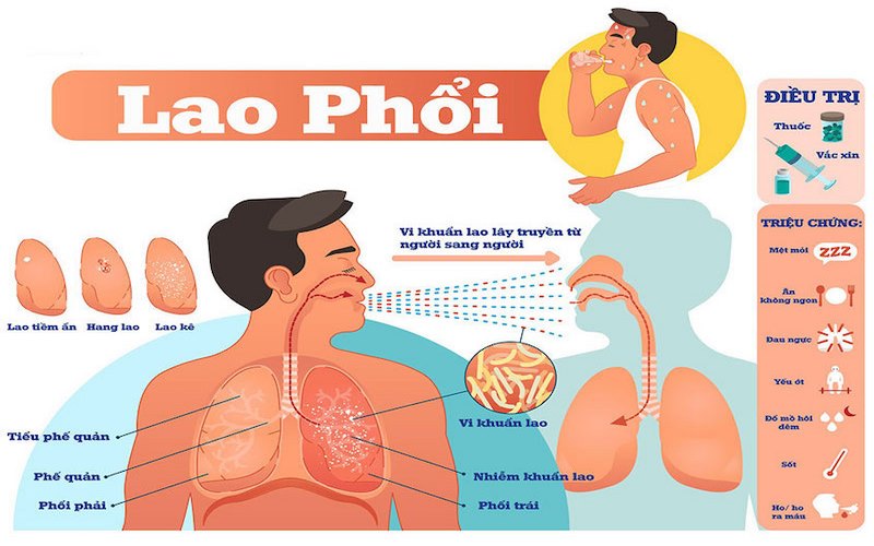 Khái quát về bệnh lao phổi