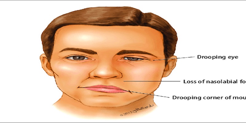 Mất cảm giác hoặc tự động chảy nước dãi từ một bộ phận của khuôn mặt