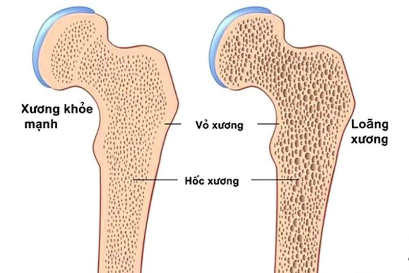 Những dấu hiệu và triệu chứng của Loãng xương ở nam giới