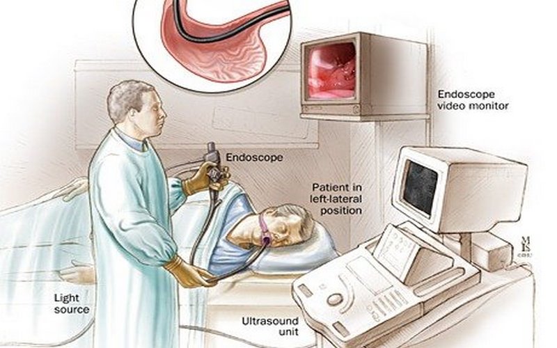 Quy trình thực hiện nội soi đường tiêu hóa trên