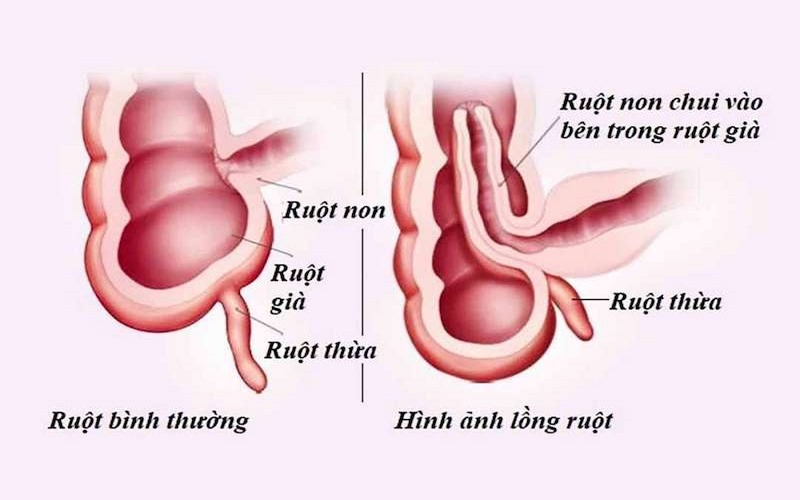 Mô phỏng hình ảnh lồng ruột