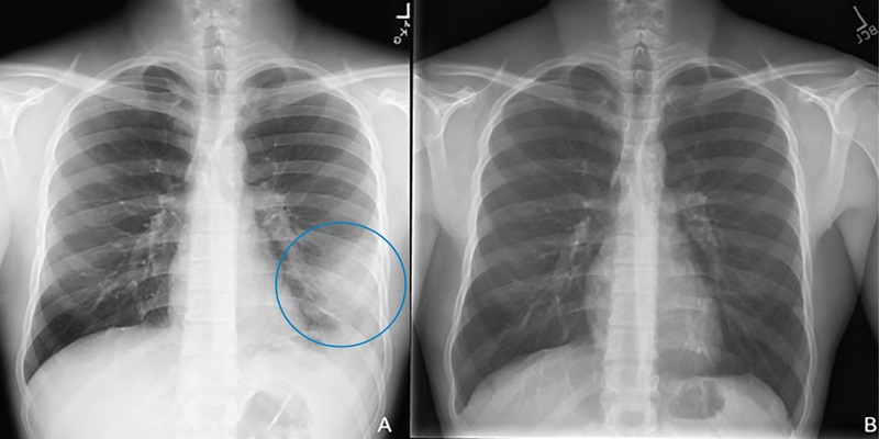 X-quang hoặc CT scan của ngực