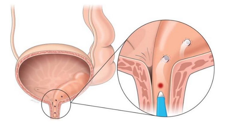 Chọc xuyên nang niệu quản giúp giữ thông đường tiểu