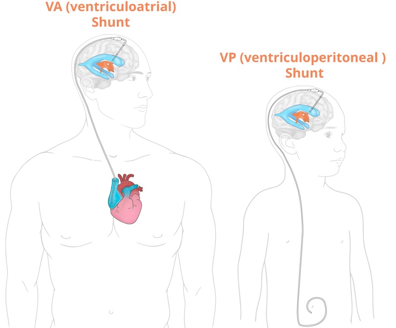 Đặt shunt là một biện pháp điều trị não úng thủy phổ biến