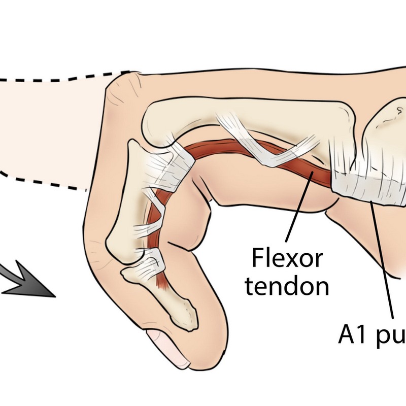 Nguyên nhân dẫn đến ngón tay lò xo