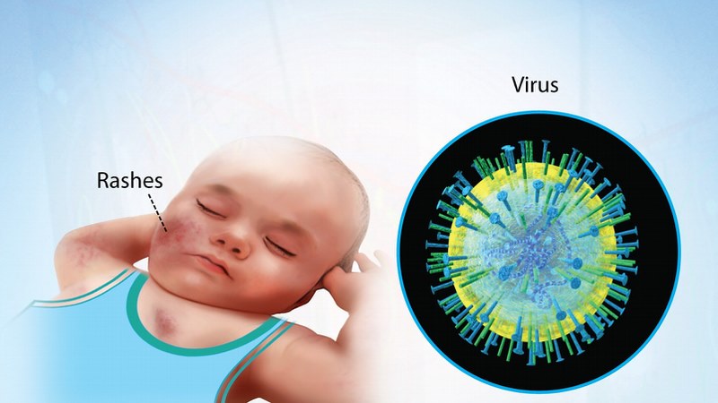 Phát ban là một trong những dấu hiệu chung của nhiễm Cytomegalovirus