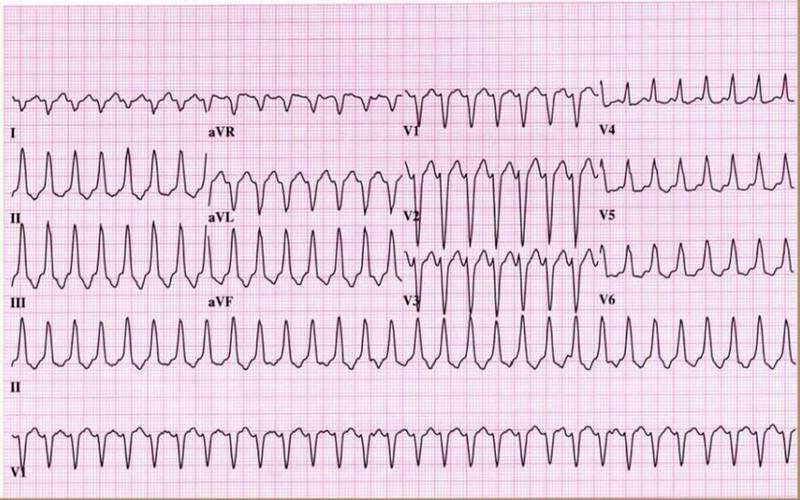 Kết quả ECG nhịp nhanh thất đơn dạng bền bỉ