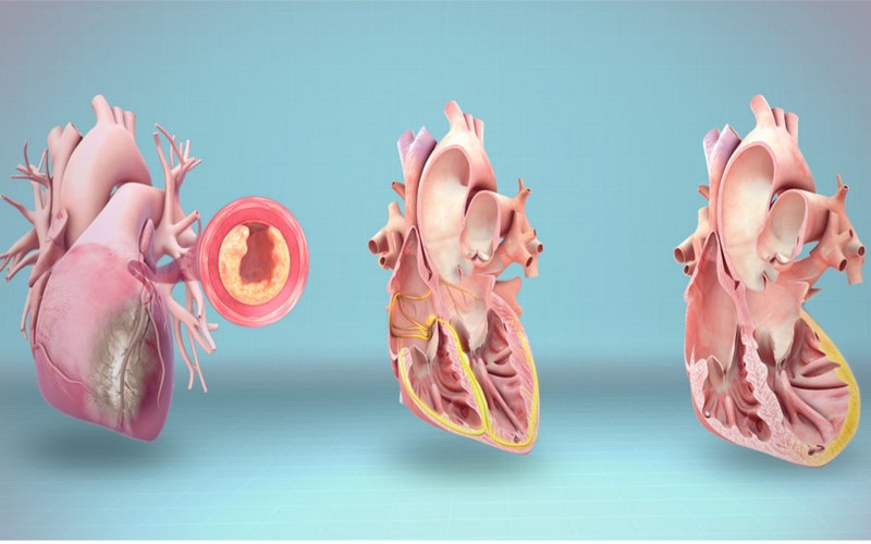 Bệnh nhân có tiền sử mắc các vấn đề về tim có nguy cơ mắc nhịp nhanh thất cao