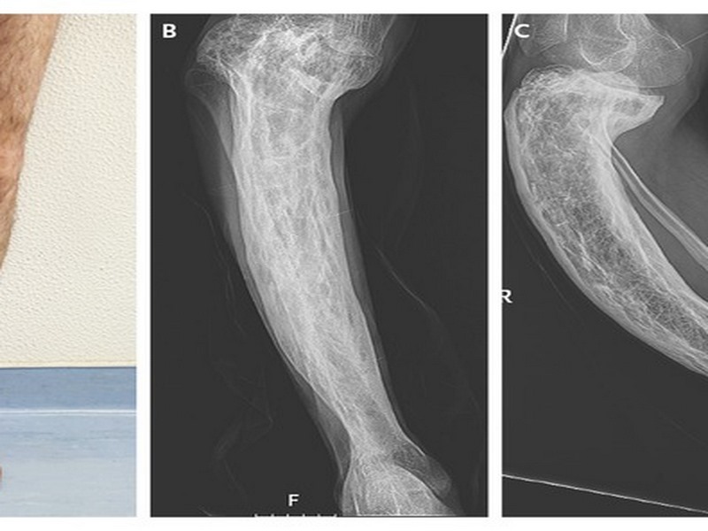 Paget xương là gì?