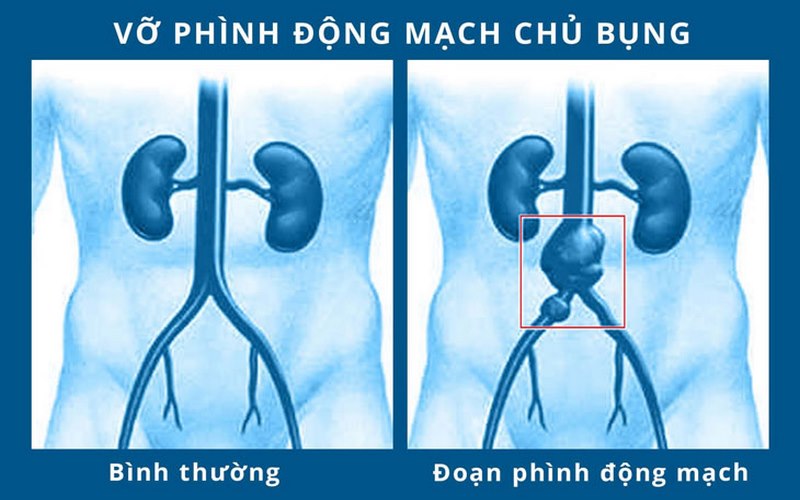 Phình động mạch chủ là bệnh lý tim mạch nguy hiểm