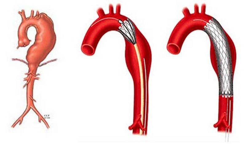 Phình động mạch chủ ngực. Đặt stent - graft trong phình động mạch chủ ngực.