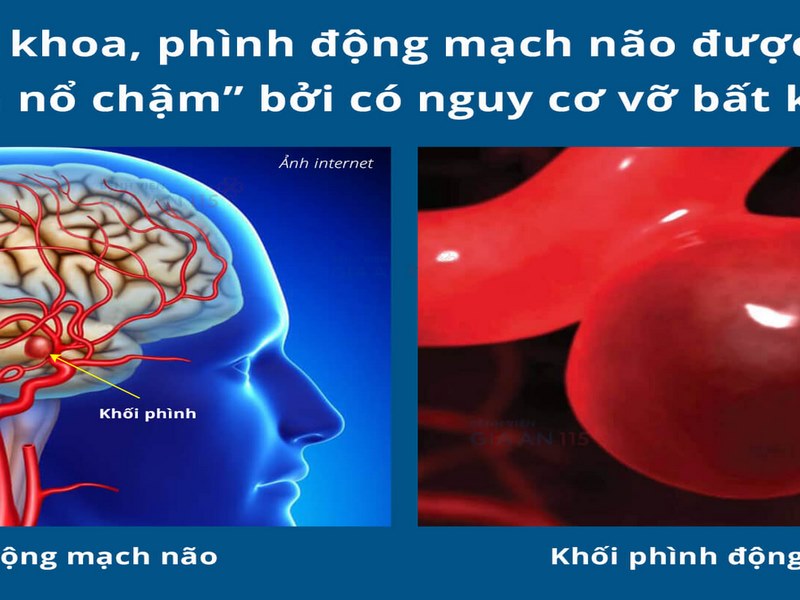 Tê liệt, yếu hoặc tự giảm hẳn ở một bên cơ thể