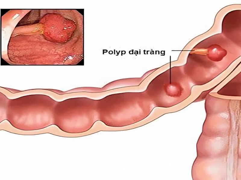 Polyp đại tràng là gì?