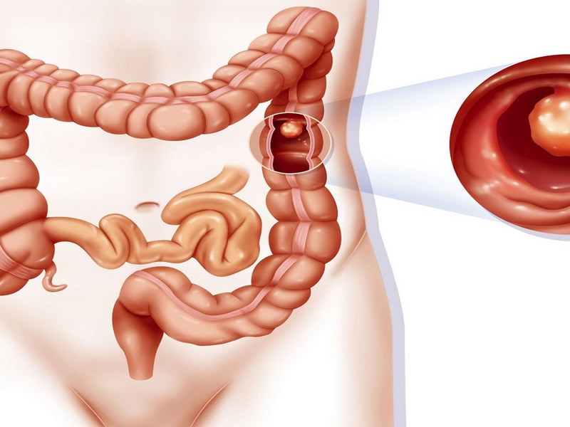 Polyp trực tràng là gì?