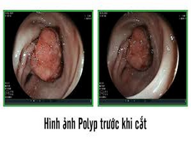 Bạn nên tăng cường ăn rau củ, hoa quả giàu chất xơ