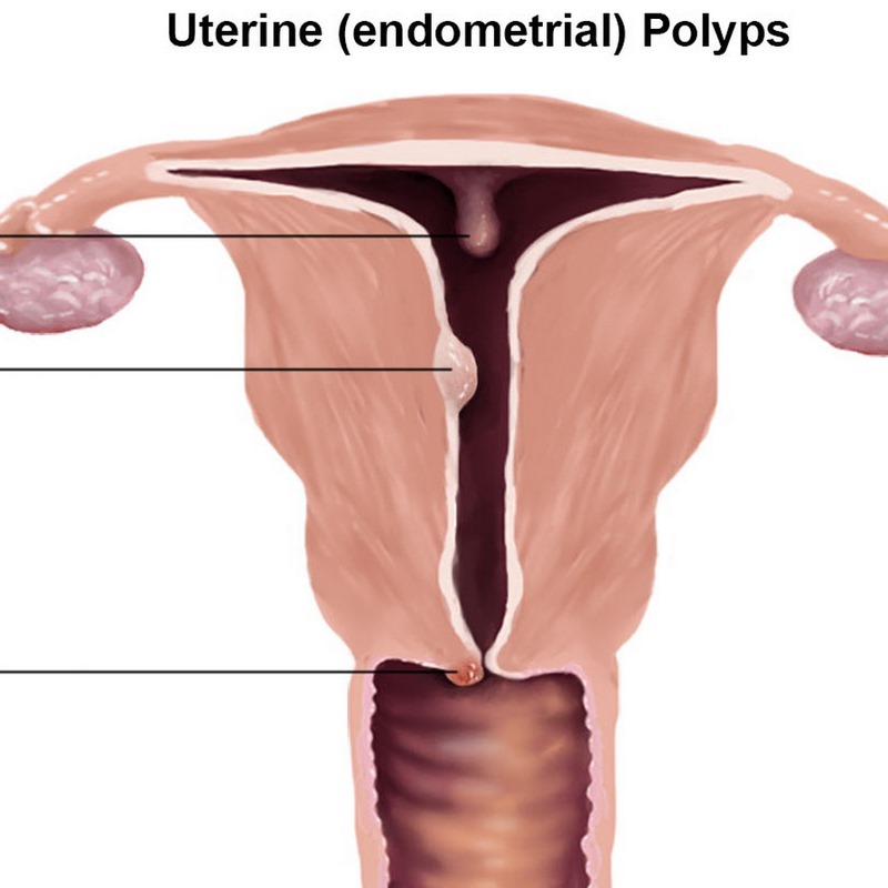 Tìm hiểu chung về polyp tử cung