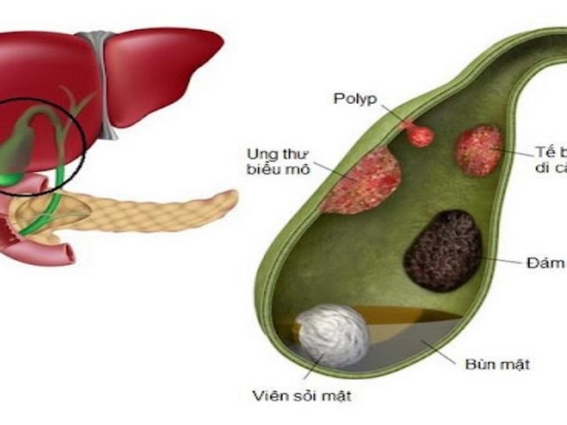 Polyp túi mật là gì?