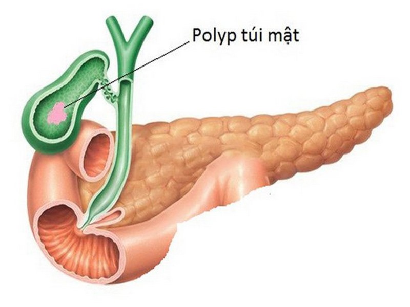 Nhiễm trùng đường mật có thể gây viêm nhiễm và phồng polyp trong túi mật