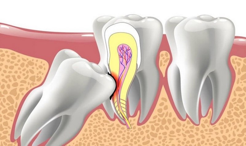 Xác định liệu răng có cần phải được di chuyển hay phải nhổ ra hay không