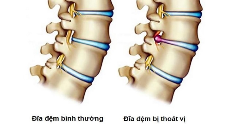 Thoát vị đĩa đệm là nguyên nhân thường gặp hiện nay