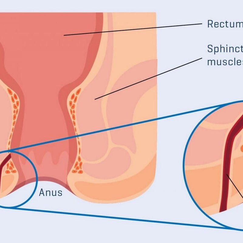 Táo bón có thể tạo áp lực lớn khi đi ngoại