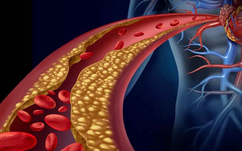 Rối loạn lipid máu thường khó phát hiện qua triệu chứng