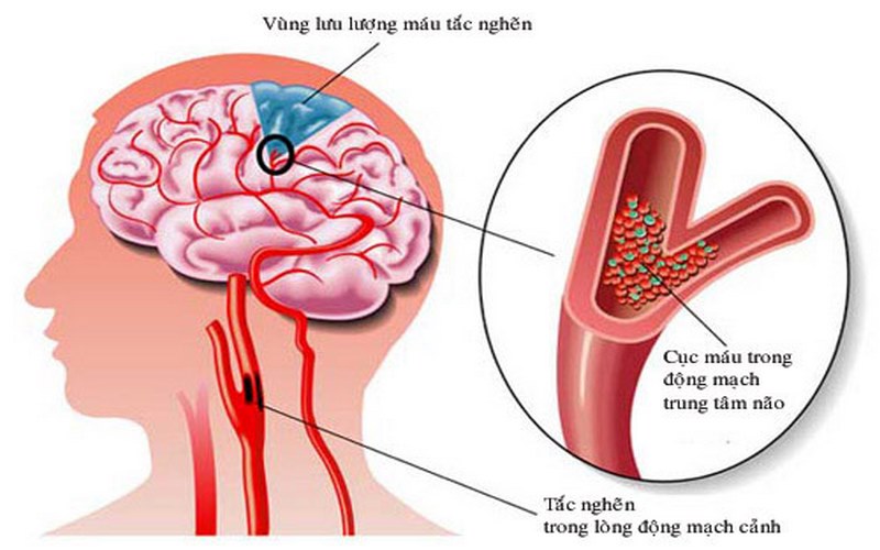 Căng thẳng, stress có thể là nguyên nhân chính gây rối loạn tiền đình